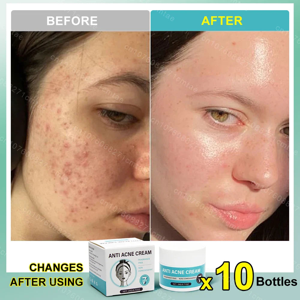 Acne Treatment Repair Acne Marks Deep Cleansing Shrink Pores Moisturizing Skin Care Products