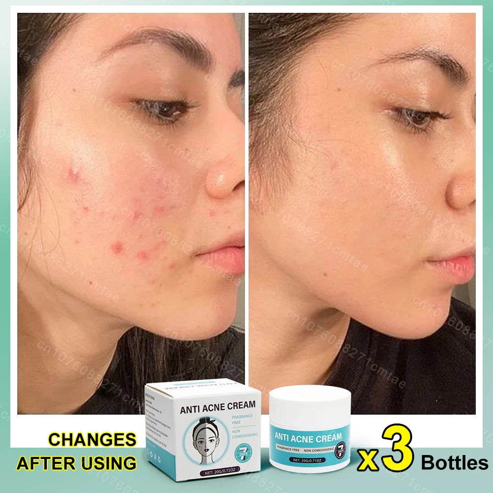 Acne Treatment Repair Acne Marks Deep Cleansing Shrink Pores Moisturizing Skin Care Products