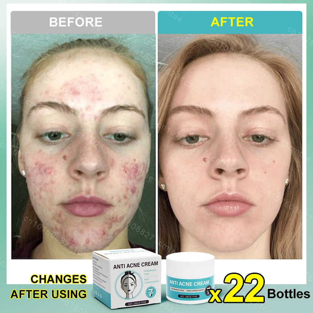 Acne Treatment Repair Acne Marks Deep Cleansing Shrink Pores Moisturizing Skin Care Products