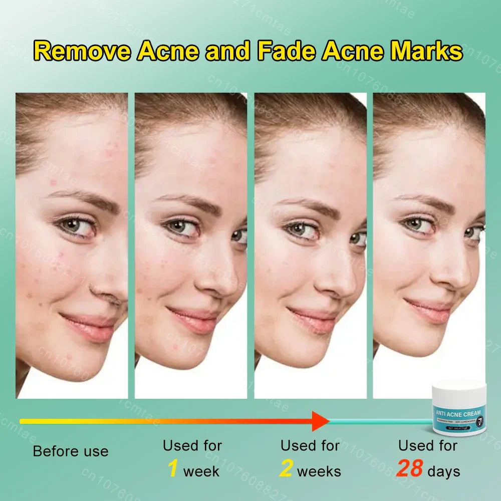 Acne Treatment Repair Acne Marks Deep Cleansing Shrink Pores Moisturizing Skin Care Products