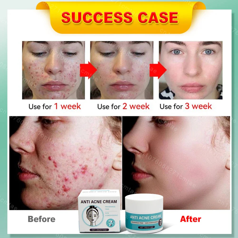 Acne Treatment Repair Acne Marks Deep Cleansing Shrink Pores Moisturizing Skin Care Products